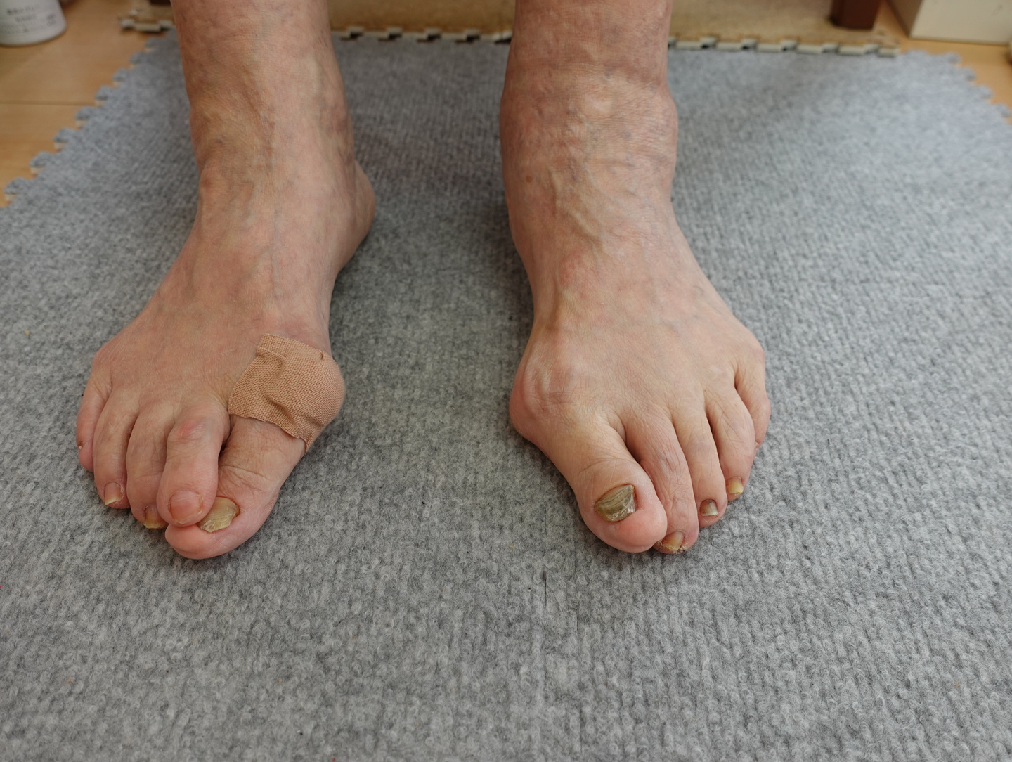 外反母趾の足