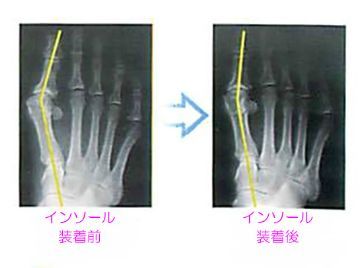 外反母趾のレントゲン画像